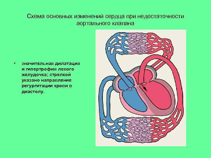 Схема основных изменений сердца при недостаточности аортального клапана • значительная дилатация и гипертрофия левого