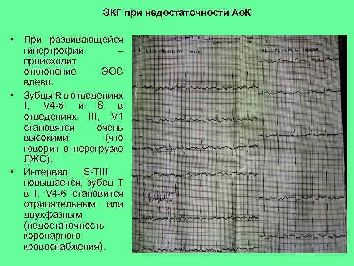 ЭКГ при недостаточности Ао. К • При развивающейся гипертрофии – происходит отклонение ЭОС влево.