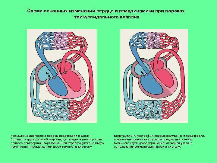 Схема гемодинамики при пороках сердца