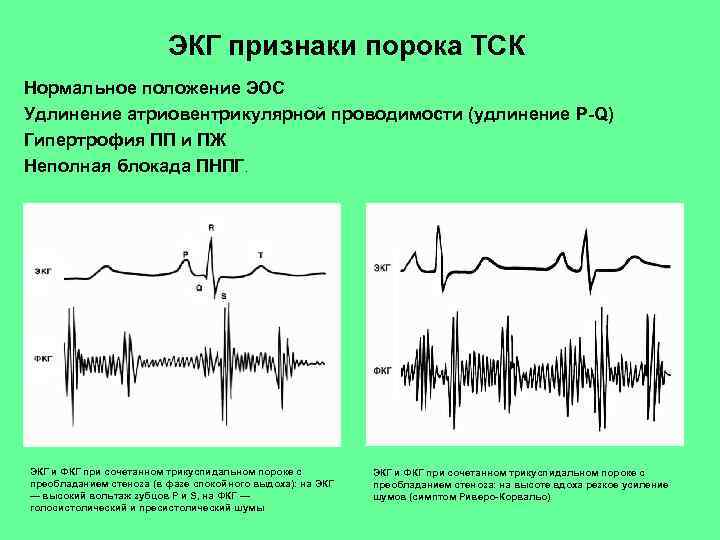 ЭКГ признаки порока ТСК Нормальное положение ЭОС Удлинение атриовентрикулярной проводимости (удлинение P-Q) Гипертрофия ПП