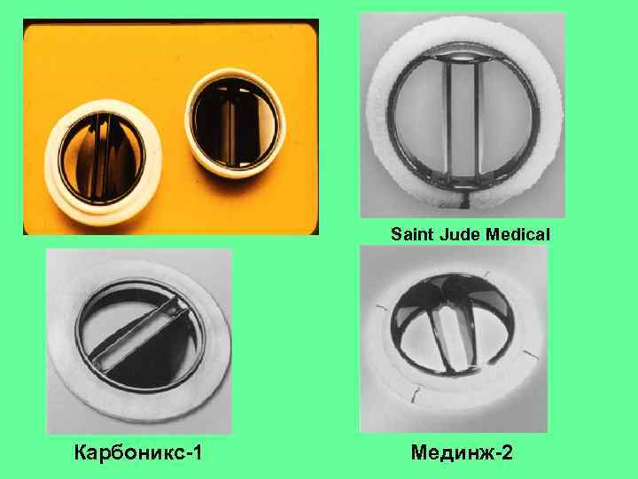 Saint Jude Medical Карбоникс-1 Мединж-2 