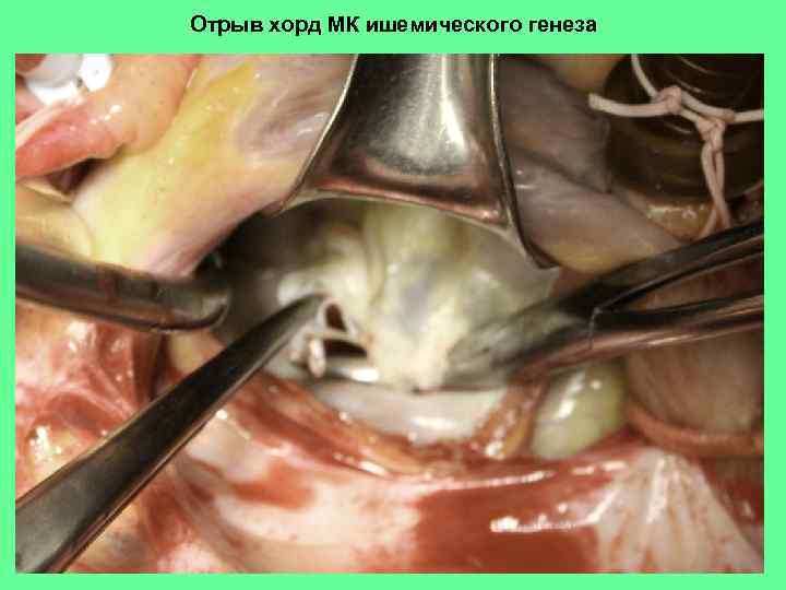 Отрыв хорд МК ишемического генеза 