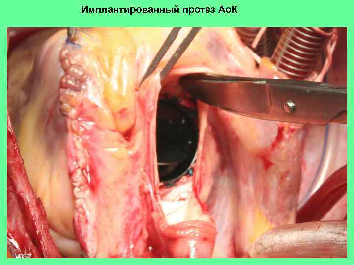 Имплантированный протез Ао. К 