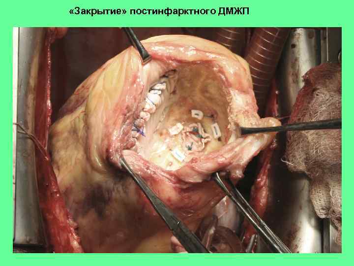  «Закрытие» постинфарктного ДМЖП 