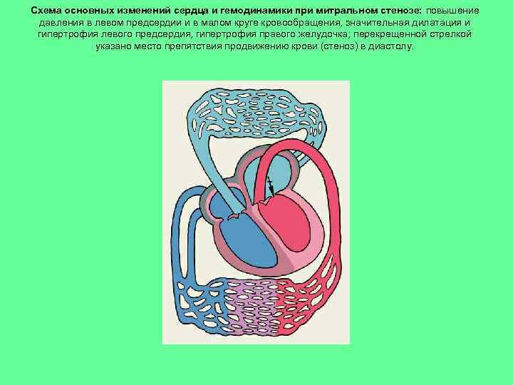 Схема основных изменений сердца и гемодинамики при митральном стенозе: повышение давления в левом предсердии