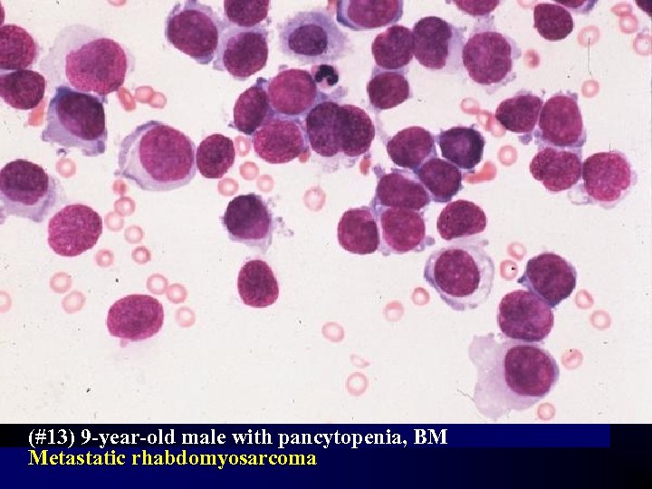 (#13) 9 -year-old male with pancytopenia, BM Metastatic rhabdomyosarcoma 