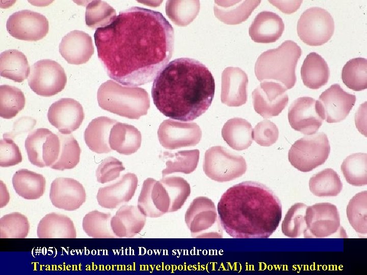 (#05) Newborn with Down syndrome Transient abnormal myelopoiesis(TAM) in Down syndrome 