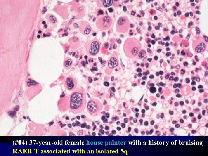 (#04) 37 -year-old female house painter with a history of bruising RAEB-T associated with