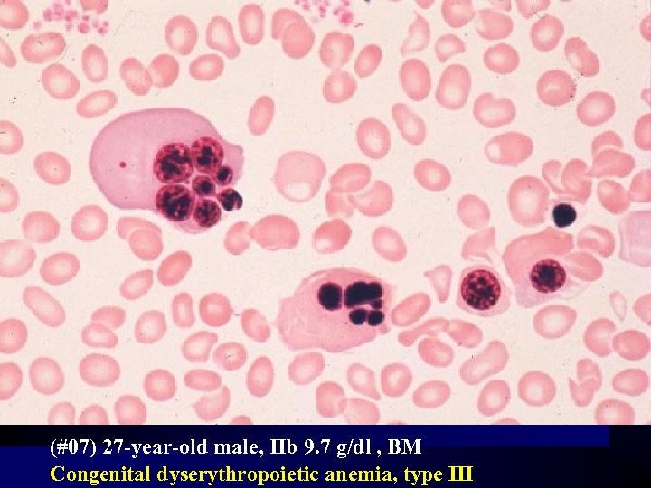 (#07) 27 -year-old male, Hb 9. 7 g/dl , BM Congenital dyserythropoietic anemia, type