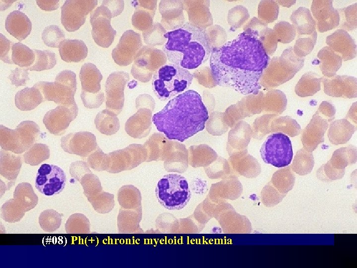 (#08) Ph(+) chronic myeloid leukemia 