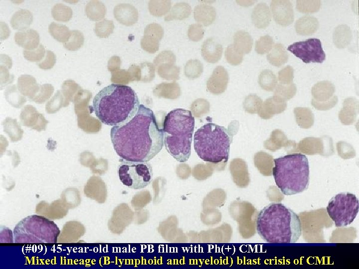 (#09) 45 -year-old male PB film with Ph(+) CML Mixed lineage (B-lymphoid and myeloid)
