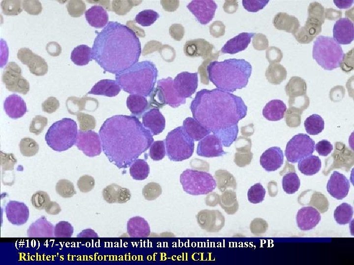 (#10) 47 -year-old male with an abdominal mass, PB Richter's transformation of B-cell CLL