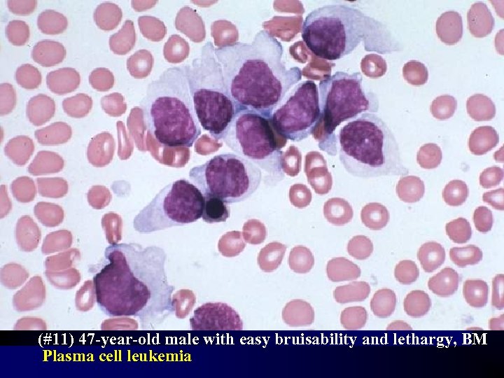 (#11) 47 -year-old male with easy bruisability and lethargy, BM Plasma cell leukemia 