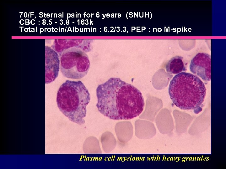 70/F, Sternal pain for 6 years (SNUH) CBC : 8. 5 - 3. 8