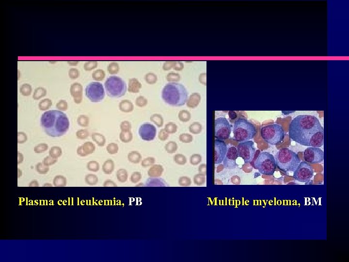 Plasma cell leukemia, PB Multiple myeloma, BM 