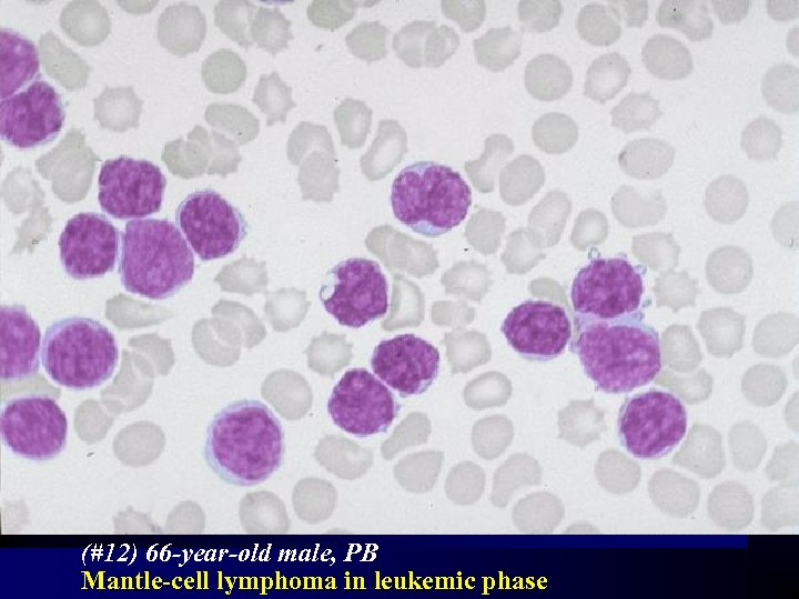 (#12) 66 -year-old male, PB Mantle-cell lymphoma in leukemic phase 
