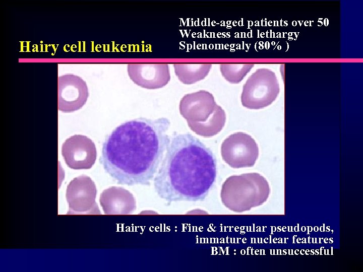 Hairy cell leukemia Middle-aged patients over 50 Weakness and lethargy Splenomegaly (80% ) Hairy