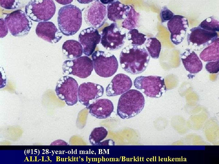 (#15) 28 -year-old male, BM ALL-L 3, Burkitt’s lymphoma/Burkitt cell leukemia 