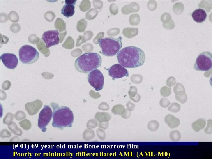 (# 01) 69 -year-old male Bone marrow film Poorly or minimally differentiated AML (AML-M