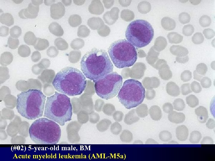 (#02) 5 -year-old male, BM Acute myeloid leukemia (AML-M 5 a) 