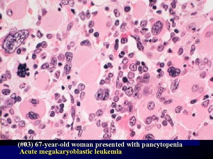 (#03) 67 -year-old woman presented with pancytopenia Acute megakaryoblastic leukemia 