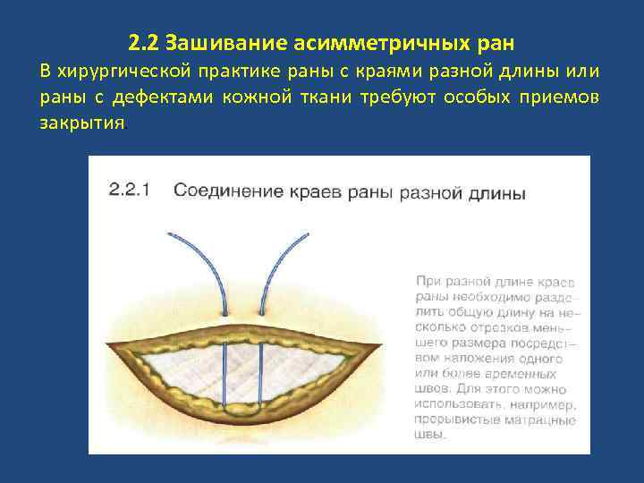 2. 2 Зашивание асимметричных ран В хирургической практике раны с краями разной длины или