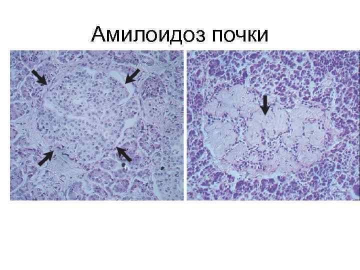 Амилоидоз почки 