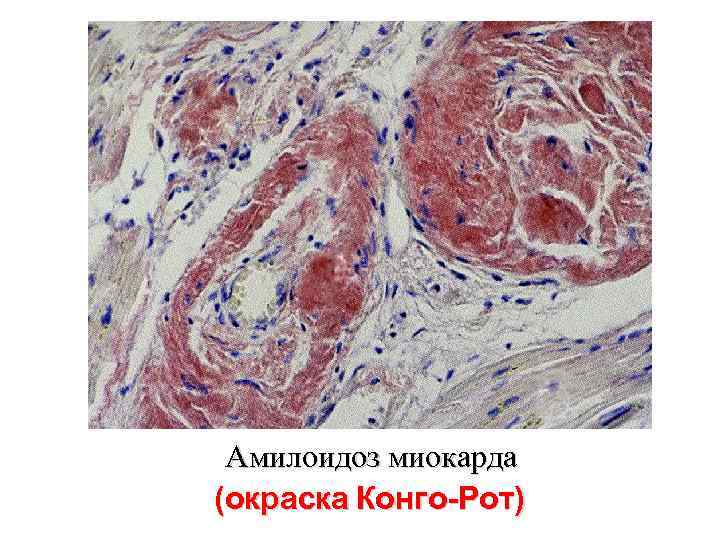 Амилоидоз миокарда (окраска Конго-Рот) 