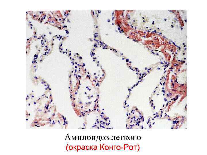 Амилоидоз легкого (окраска Конго-Рот) 