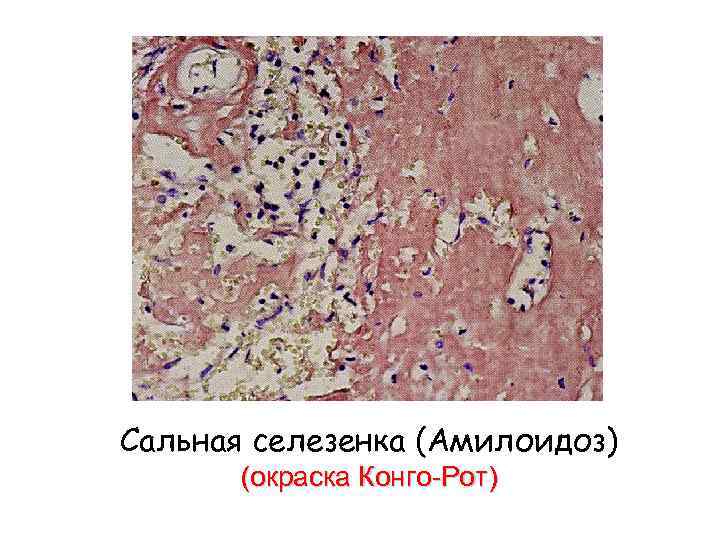 Сальная селезенка (Амилоидоз) (окраска Конго-Рот) 