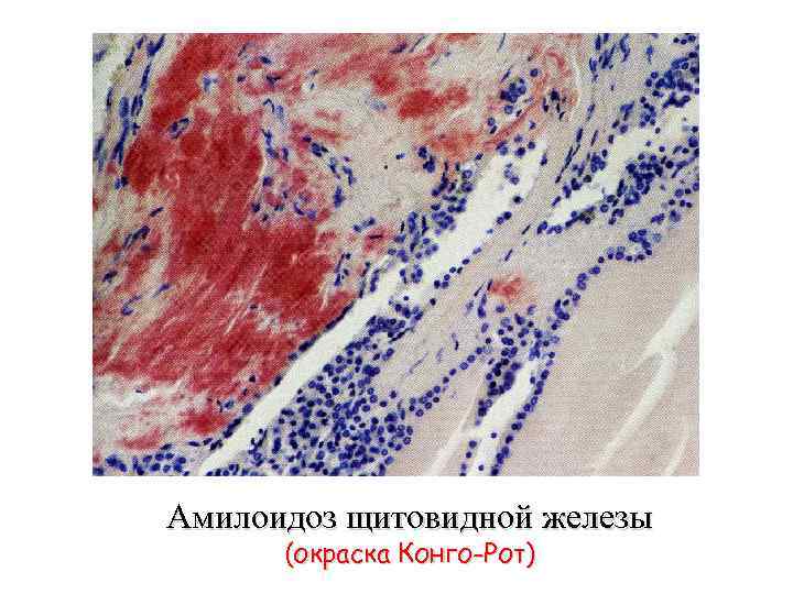 Амилоидоз щитовидной железы (окраска Конго-Рот) 