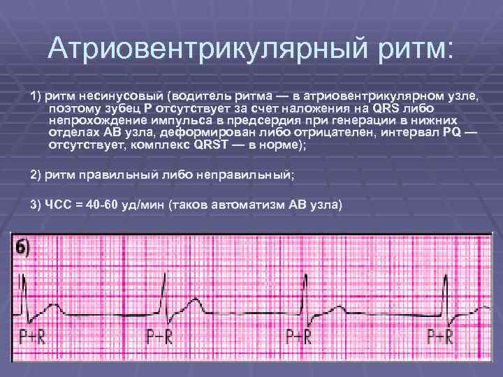 Атриовентрикулярный ритм: 1) ритм несинусовый (водитель ритма — в атриовентрикулярном узле, поэтому зубец P