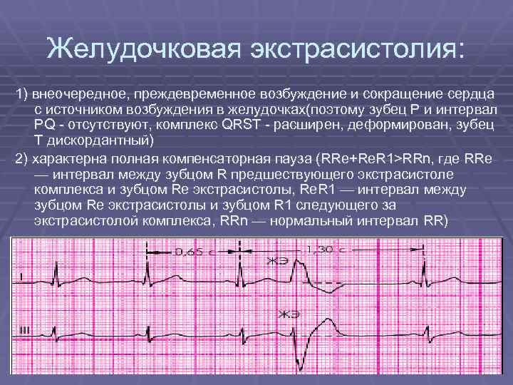 Желудочковая экстрасистолия: 1) внеочередное, преждевременное возбуждение и сокращение сердца с источником возбуждения в желудочках(поэтому