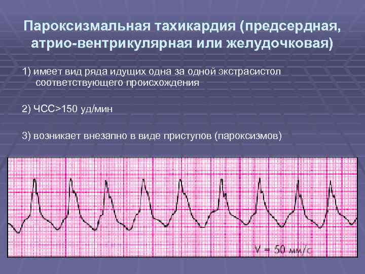 Тахикардия при беременности. Предсердная пароксизмальная тахикардия на ЭКГ. Желудочковая и предсердная тахикардия на ЭКГ. ЭКГ при предсердной пароксизмальной тахикардии. ЭКГ критерии предсердной тахикардии.