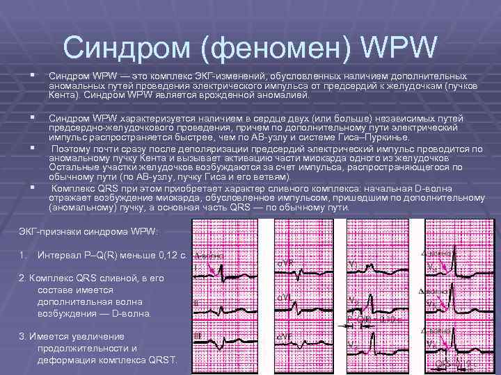 Wpw на экг фото