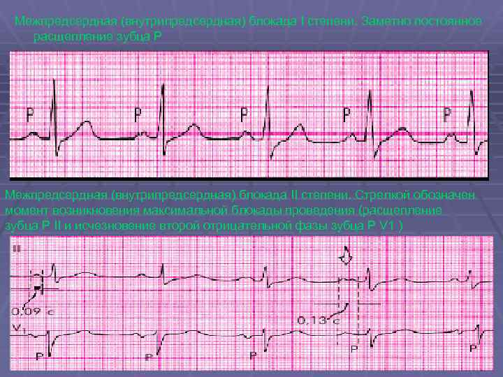Внутрипредсердная проводимость. Внутрипредсердная блокада на ЭКГ. Внутрипредсердная блокада 2 степени. Межпредсердная блокада на ЭКГ. Межпредсердная блокада 2 степени ЭКГ.