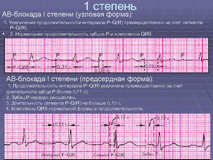 Ав блокада 1