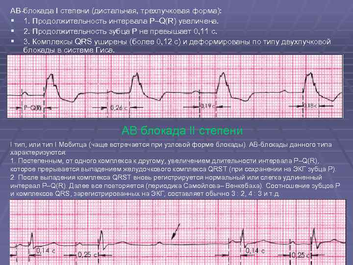 Комплекс блокада. Атриовентрикулярная блокада 1 степени на ЭКГ. ЧСС при АВ блокаде 1 степени. АВ блокада 1 степени на ЭКГ. АВ блокада 2 степени PQ.