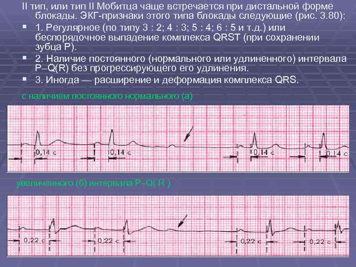 Экг блокада 1 степени что это