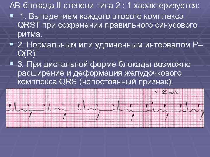 АВ-блокада II степени типа 2 : 1 характеризуется: § 1. Выпадением каждого второго комплекса