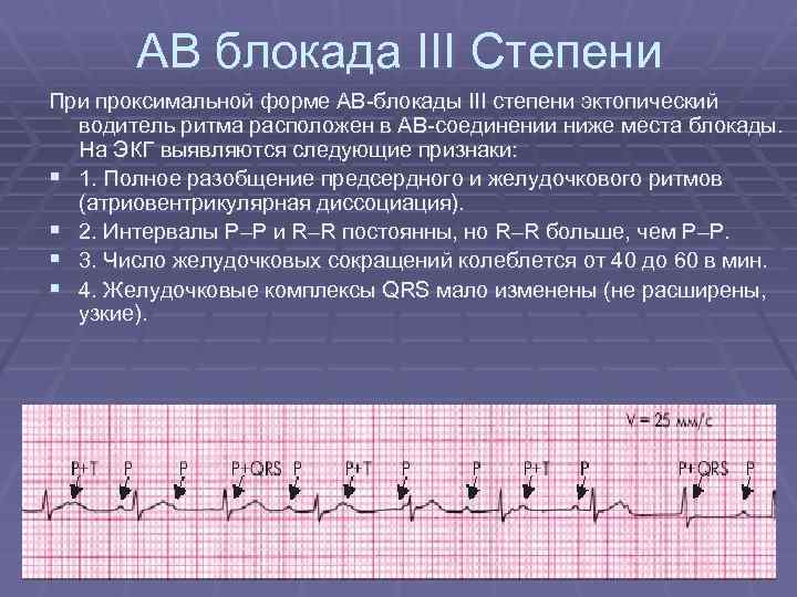 Ав блокада степени. Признаки av блокады 3 степени на ЭКГ. Полная атриовентрикулярная блокада 3 степени на ЭКГ. Степени атриовентрикулярной блокады на ЭКГ. Неполная АВ блокада 1 степени на ЭКГ.