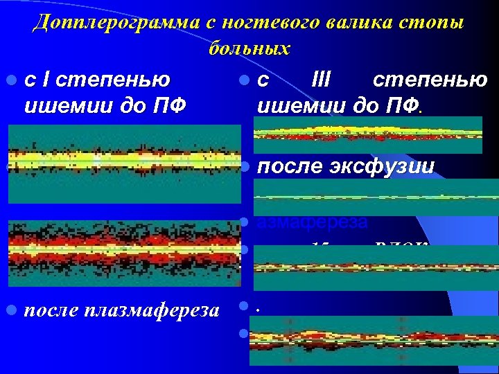 Допплерограмма с ногтевого валика стопы больных с I степенью с III степенью ишемии до