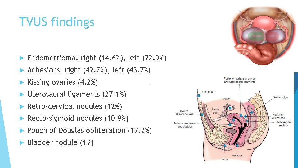 TVUS findings Endometrioma: right (14. 6%), left (22. 9%) Adhesions: right (42. 7%), left