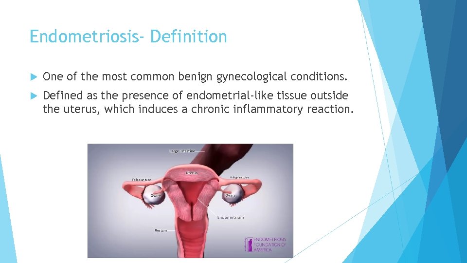 Endometriosis‐ Definition One of the most common benign gynecological conditions. Defined as the presence