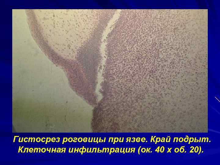 Гистосрез роговицы при язве. Край подрыт. Клеточная инфильтрация (ок. 40 х об. 20). 