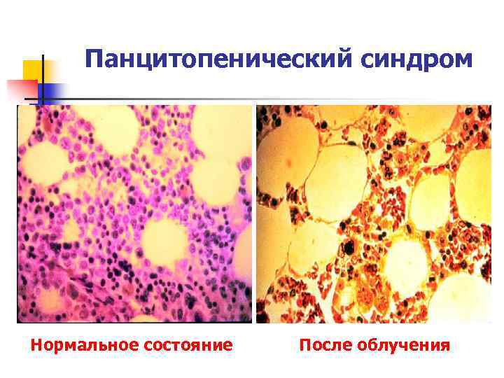 Панцитопенический синдром Нормальное состояние После облучения 