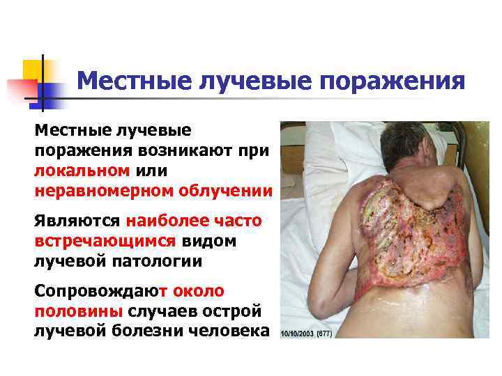 Местные лучевые поражения возникают при локальном или неравномерном облучении Являются наиболее часто встречающимся видом