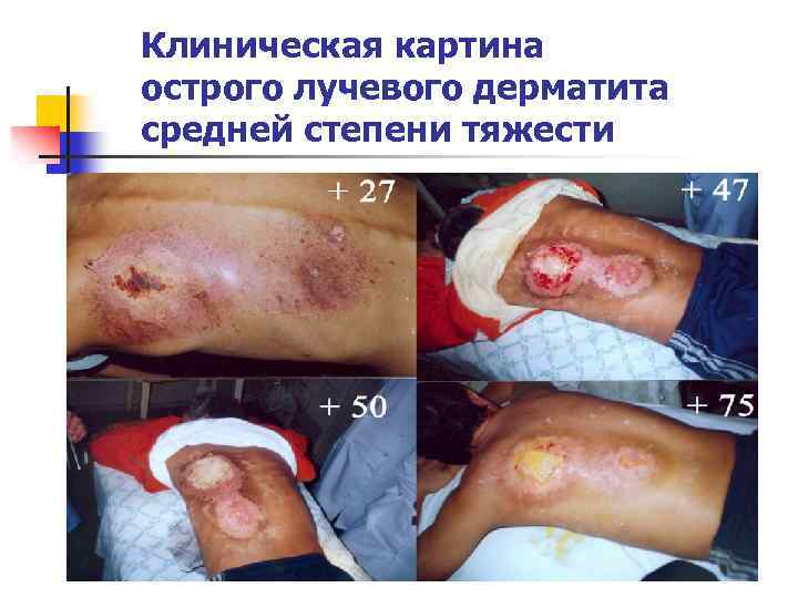 Клиническая картина острого лучевого дерматита средней степени тяжести 