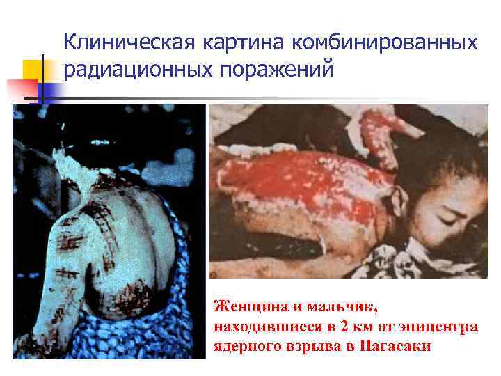 Клиническая картина комбинированных радиационных поражений Женщина и мальчик, находившиеся в 2 км от эпицентра