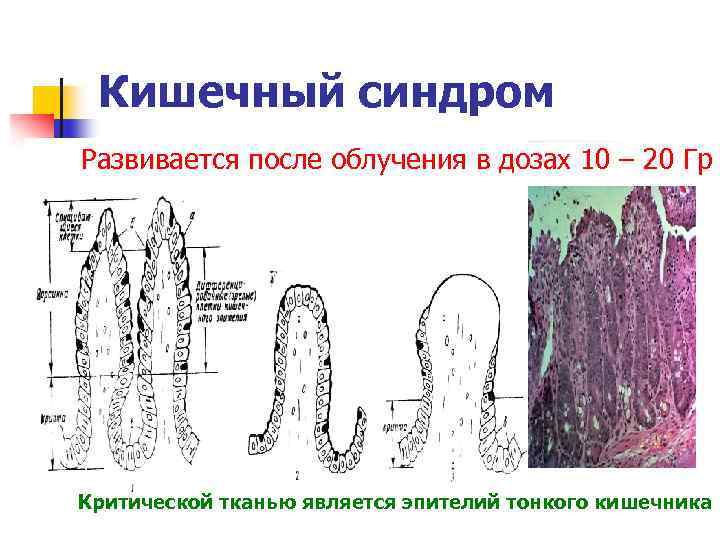 Кишечный синдром Развивается после облучения в дозах 10 – 20 Гр Критической тканью является